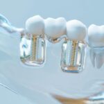 Free dental implant programs!