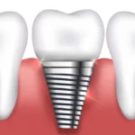 ¡Cómo conseguir implantes dentales gratis!